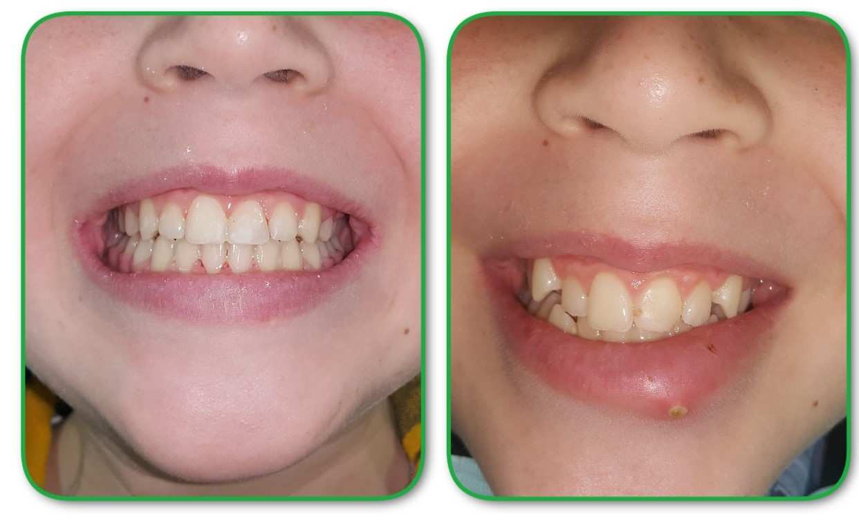 Orthodontics | Dr. Ernesto Shachner