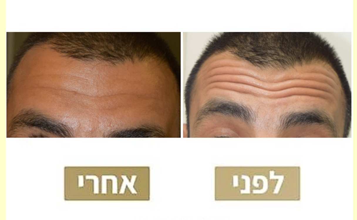 حقن بوتوكس | د. موني فريدمان