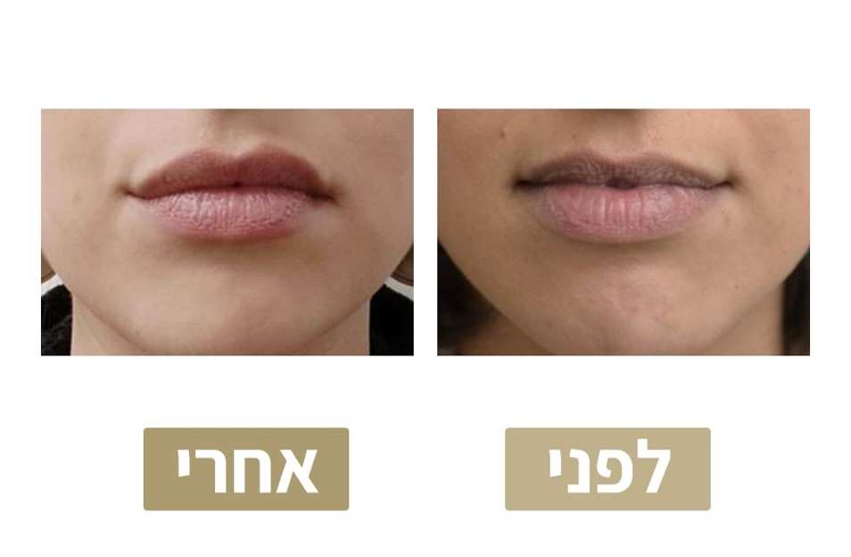 Restylane Injection | Dr. Mony Friedman