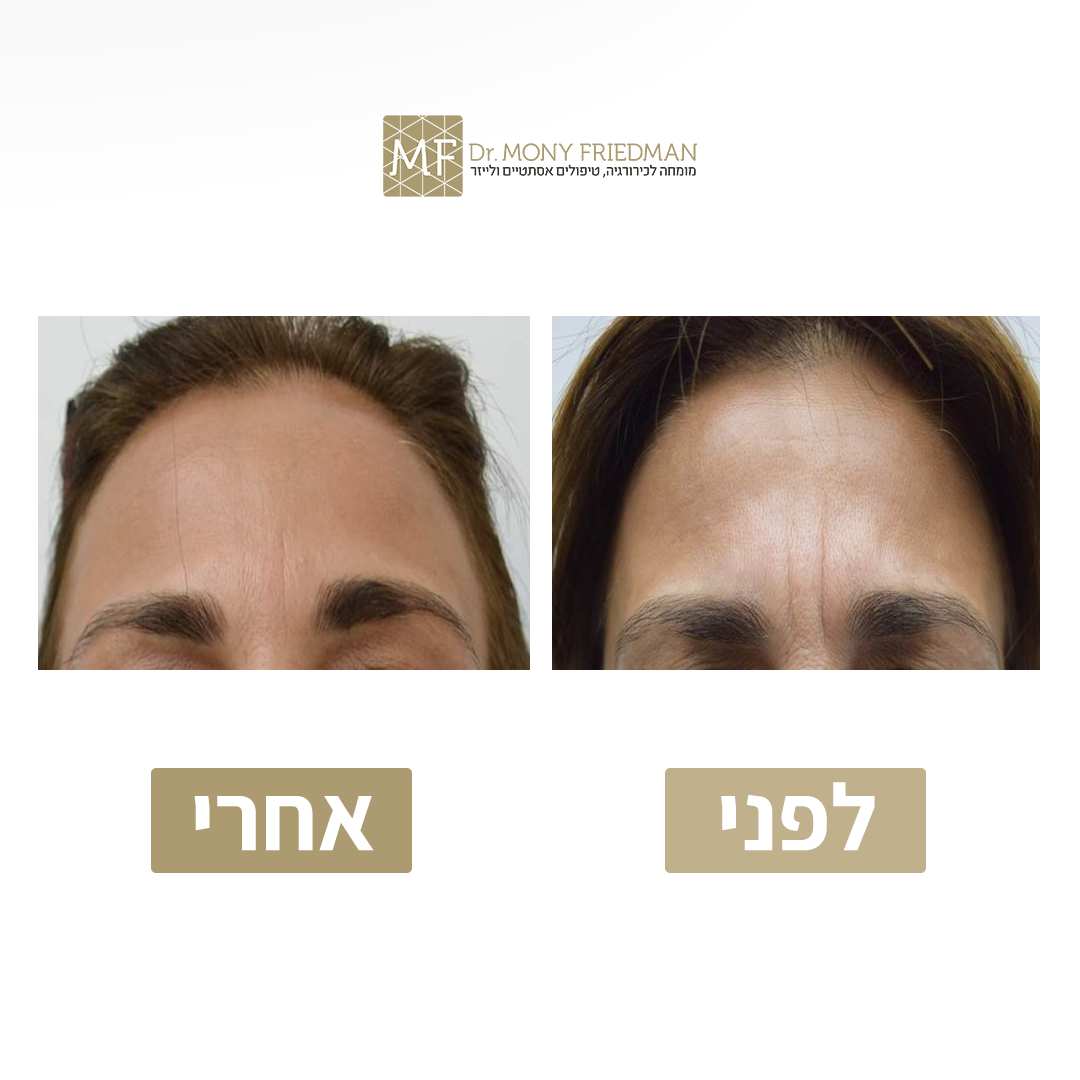 Botox Injection | Dr. Mony Friedman