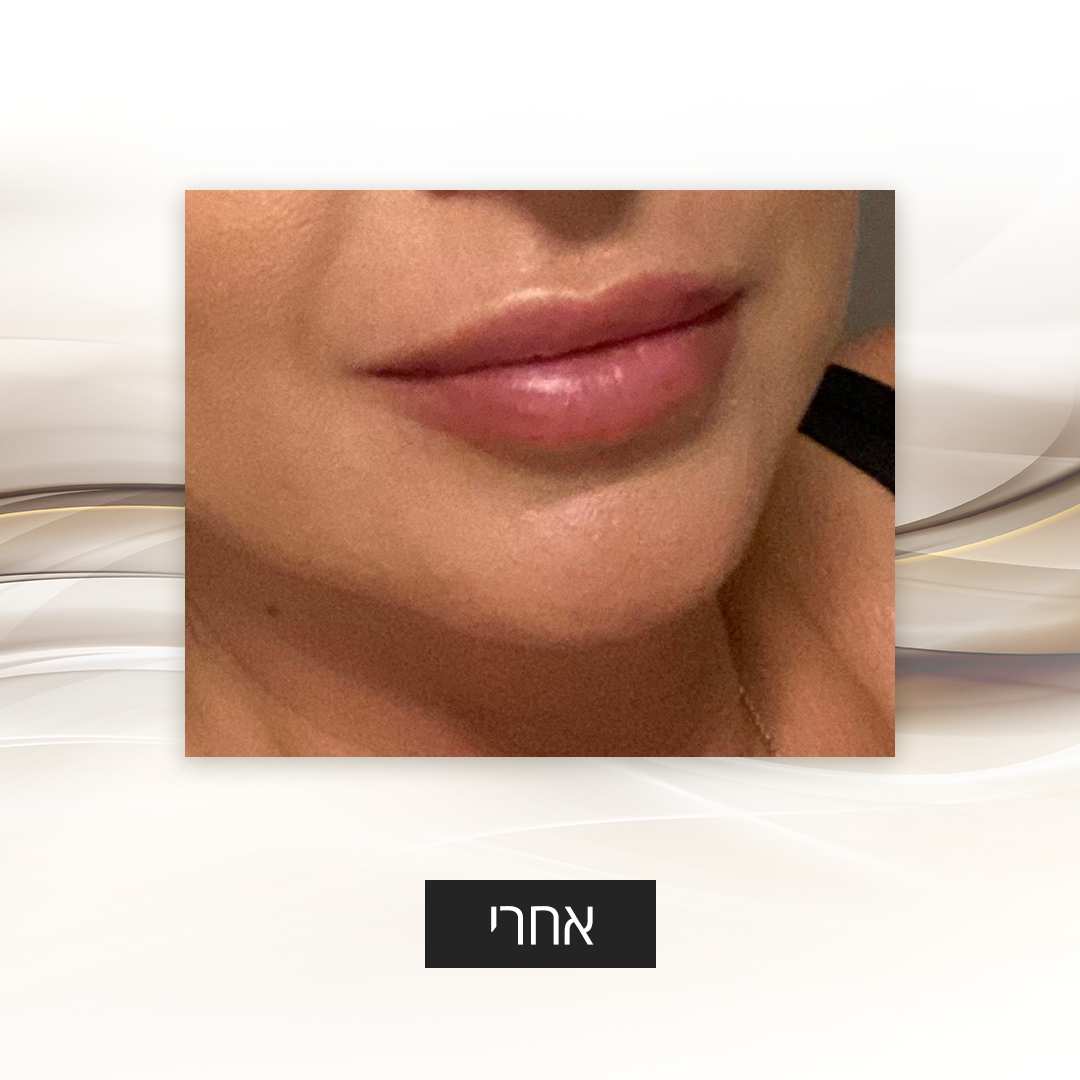 Lip Thickening | Dr. Mony Friedman