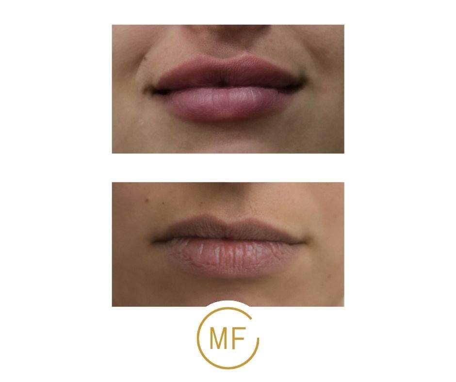 Restylane Injection | Dr. Mony Friedman