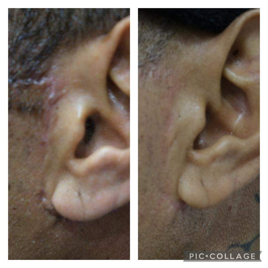 Scar Removal | Dr. Mony Friedman
