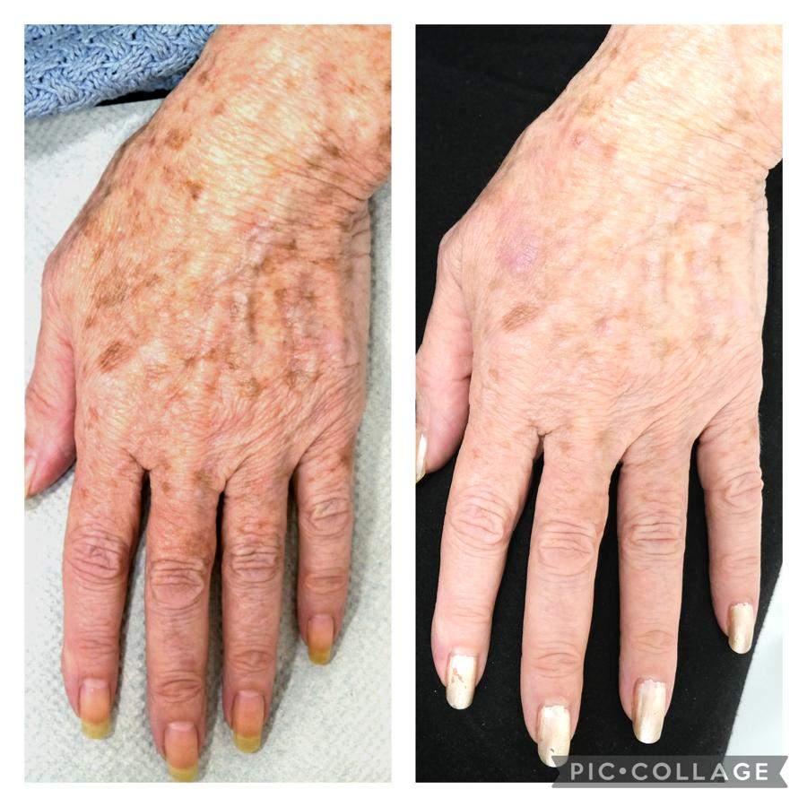 Pigmentation Removal | Dr. Mony Friedman