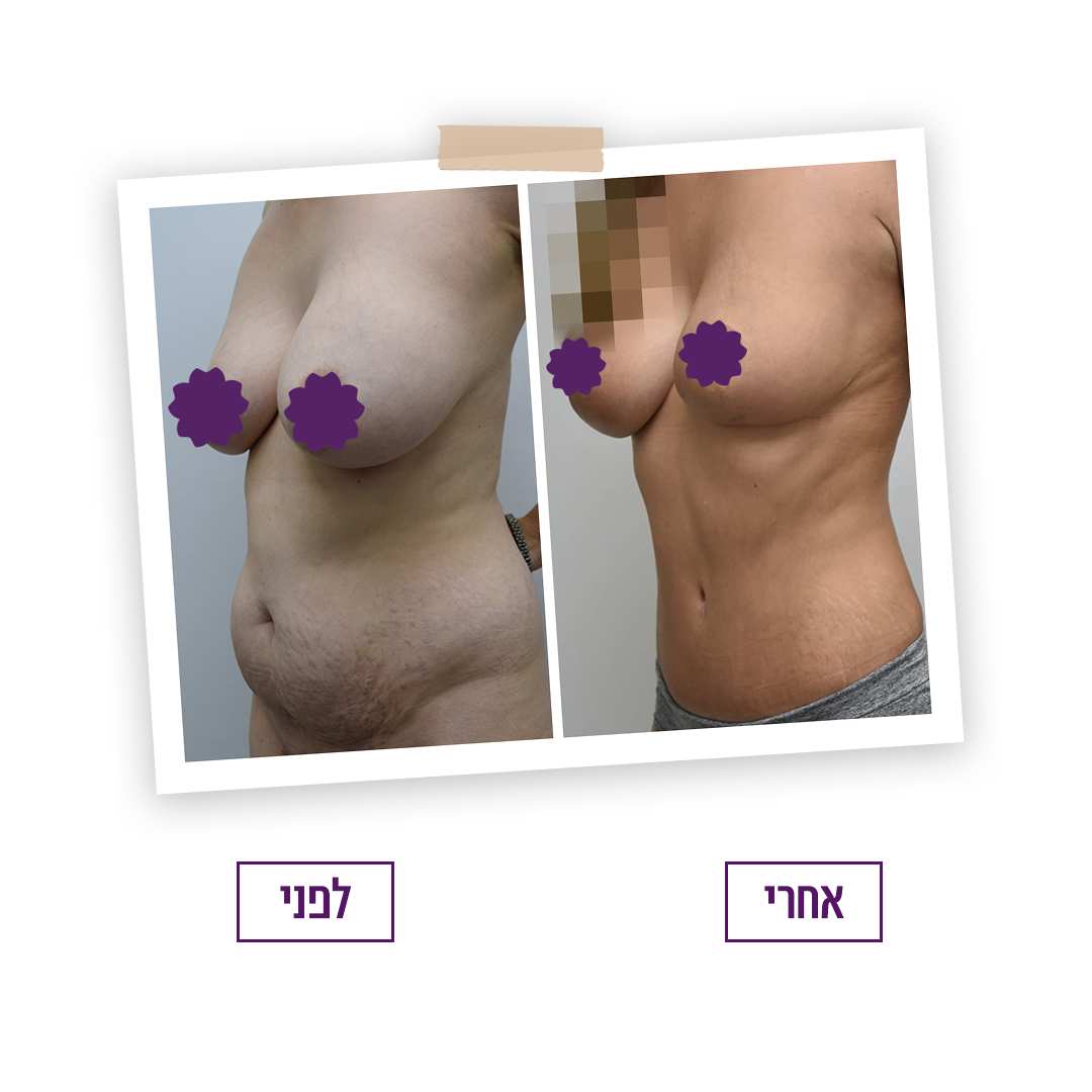 ‎(Mommy Makeover) ‎تجميل ما بعد الولادة‎ | د. طالي فريدمان