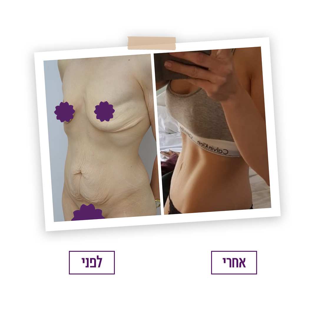 Mommy Makeover | Dre Tali Friedman