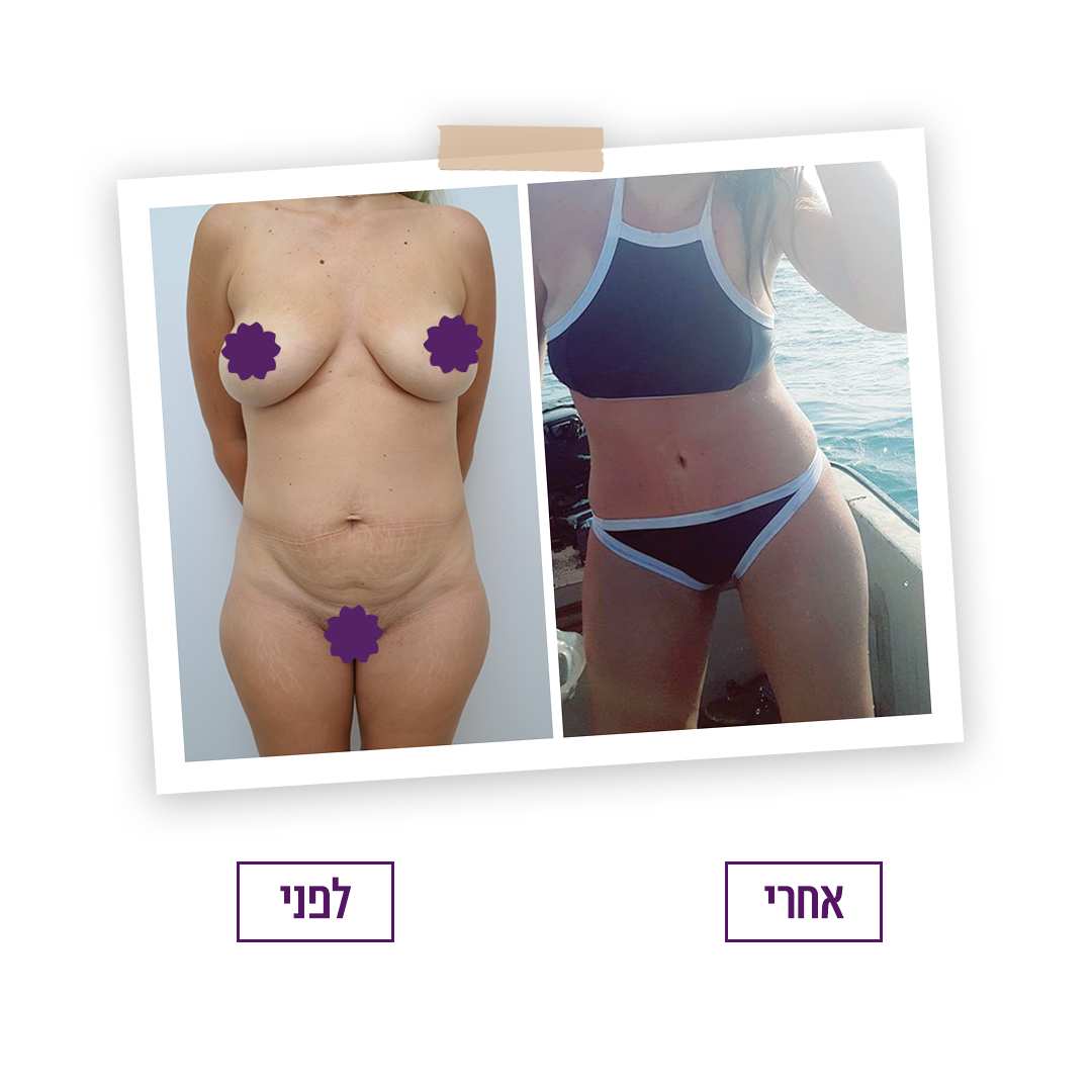 Mommy Makeover | Dr. Tali Friedman