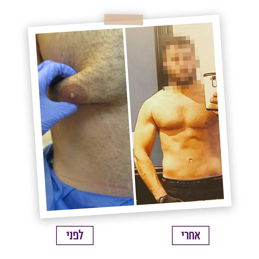 Gynecomastia | Dr. Tali Friedman