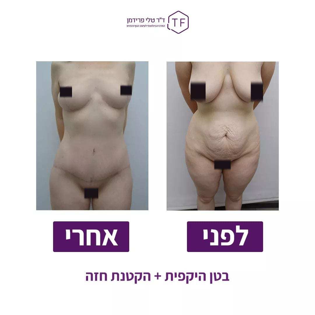 Mommy Makeover | Dr. Tali Friedman