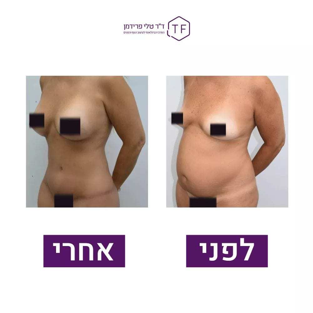 Lifting Des Seins  | Dre Tali Friedman