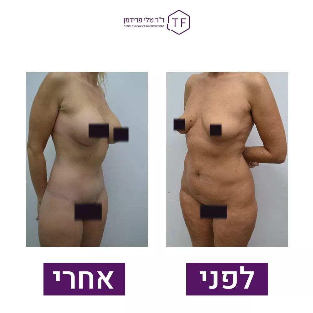 Abdominoplastie - Lifting Du Ventre | Dre Tali Friedman