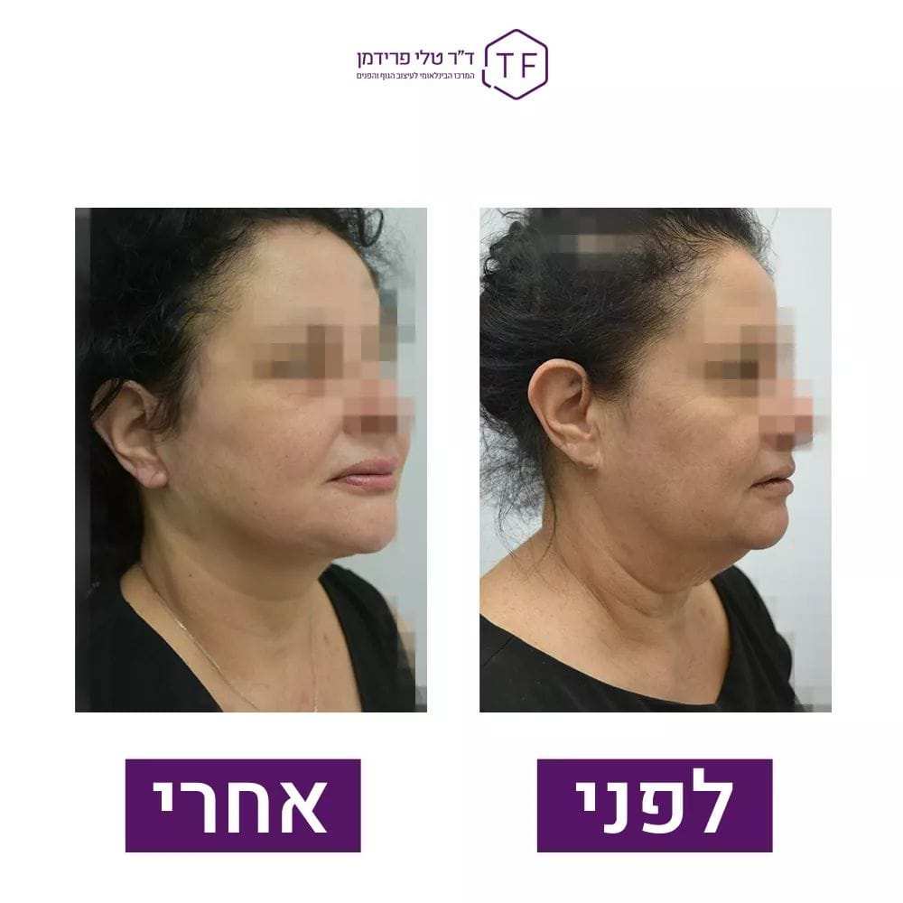 Lifting De La Face Et Du Cou | Dre Tali Friedman
