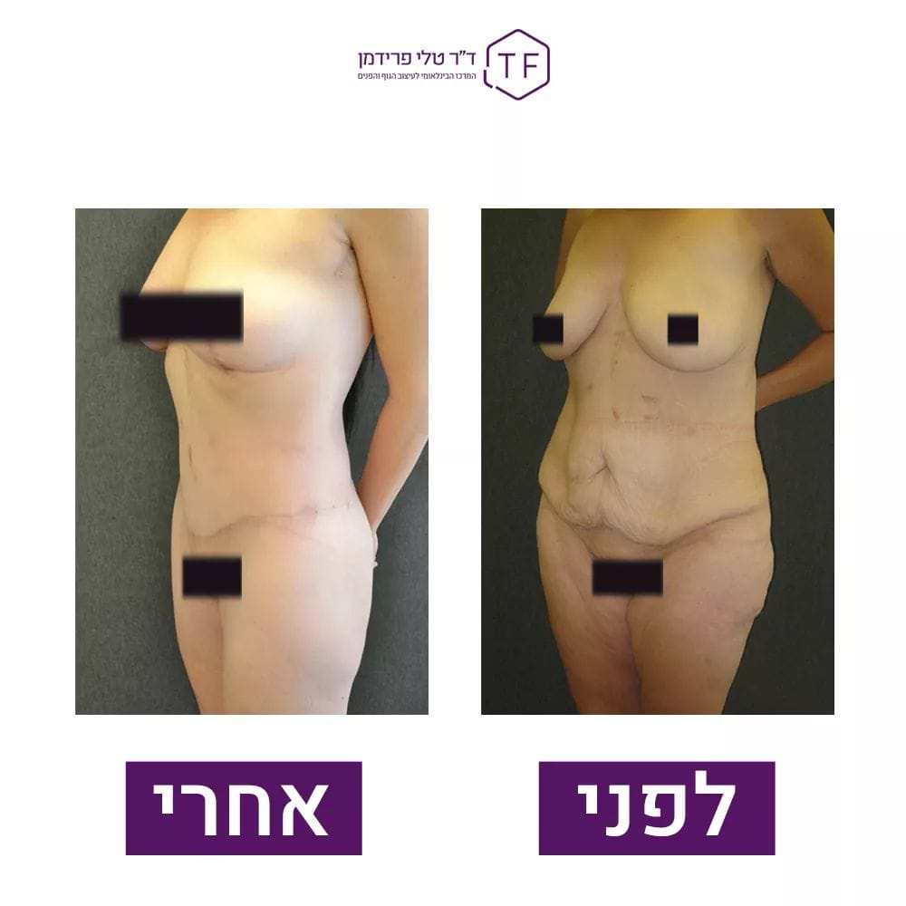 Abdominoplastie - Lifting Du Ventre | Dre Tali Friedman