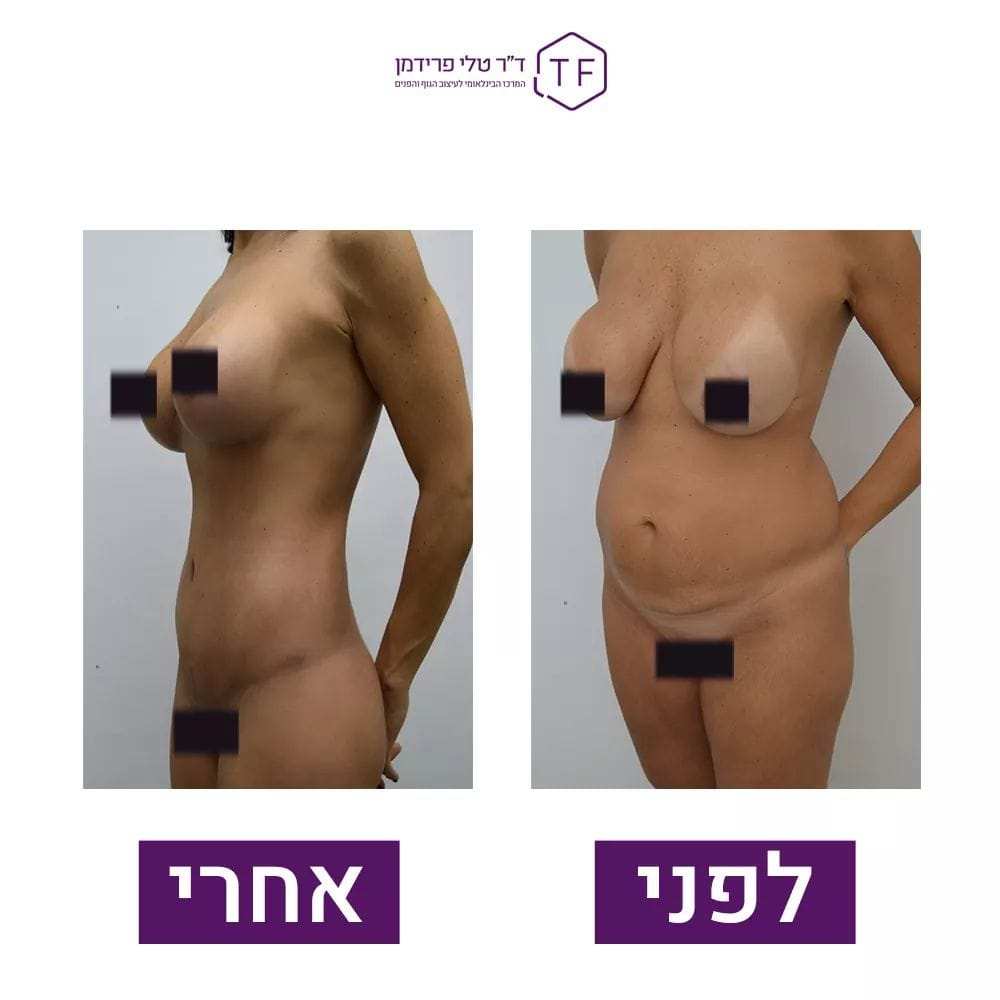 Abdominoplastie - Lifting Du Ventre | Dre Tali Friedman