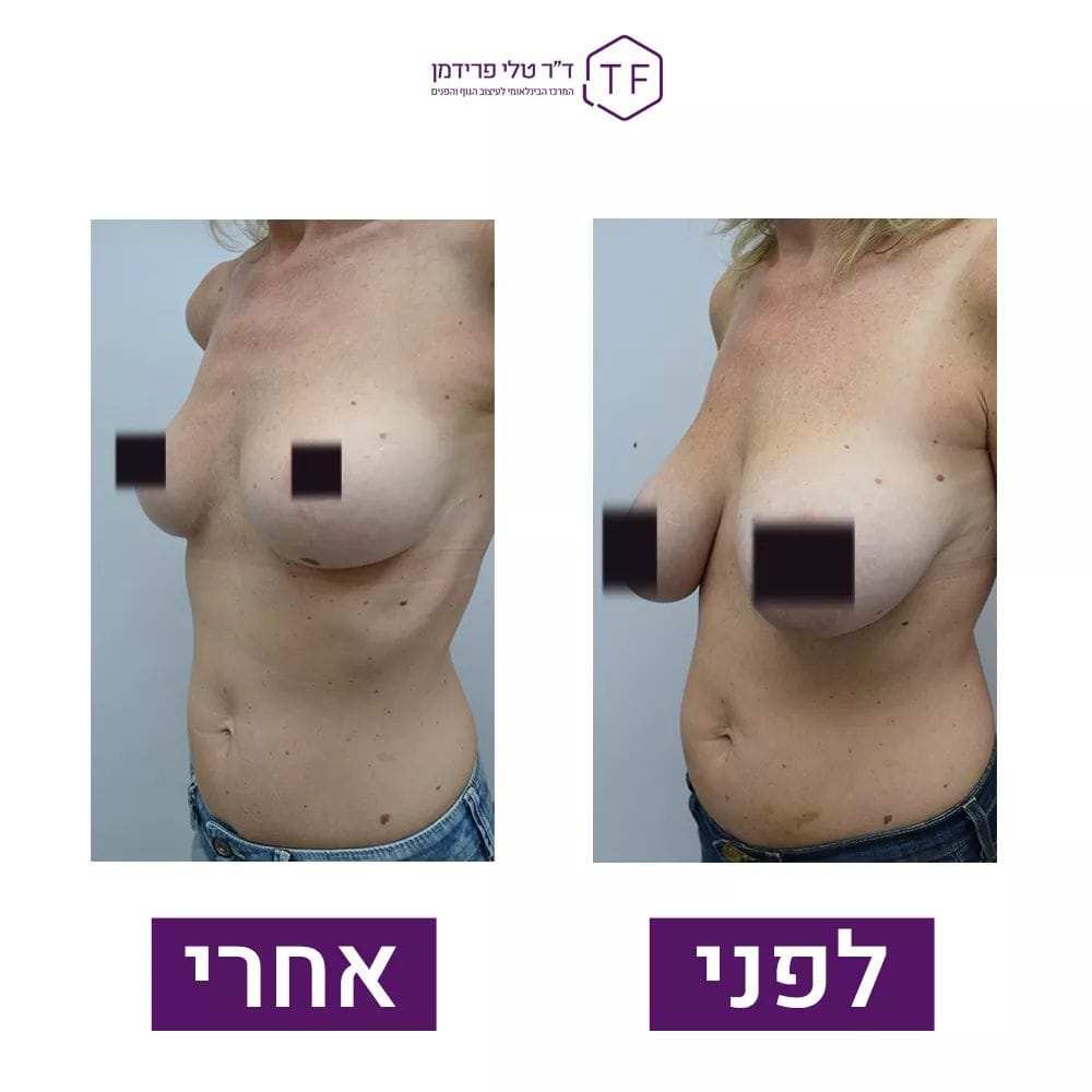 Réduction Mammaire | Dre Tali Friedman