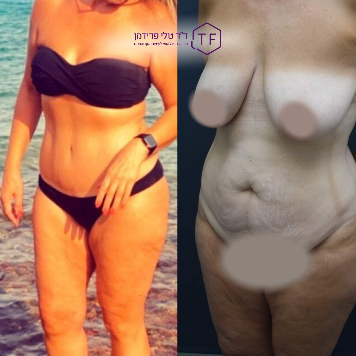 Abdominoplastie - Lifting Du Ventre | Dre Tali Friedman