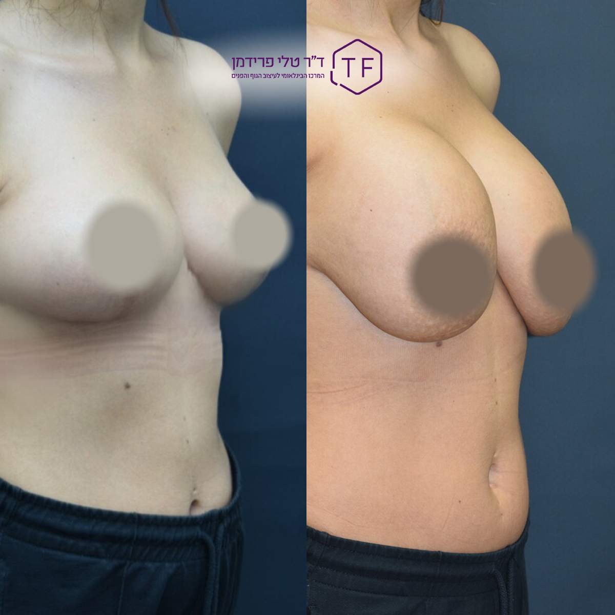 Lifting Des Seins  | Dre Tali Friedman