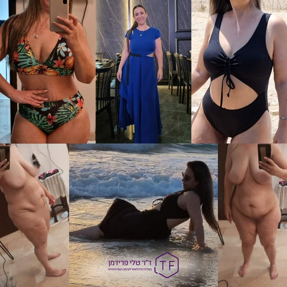 Abdominoplastie - Lifting Du Ventre | Dre Tali Friedman