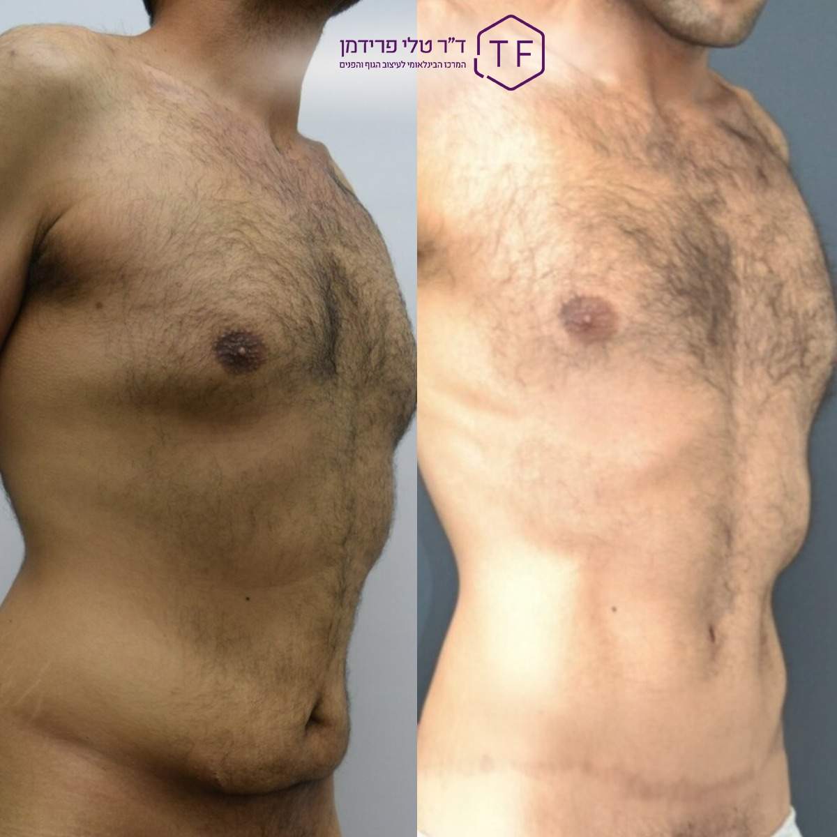 Abdominoplastie - Lifting Du Ventre | Dre Tali Friedman