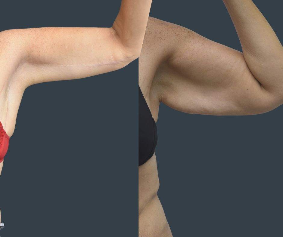Lifting Des Bras | Dre Tali Friedman