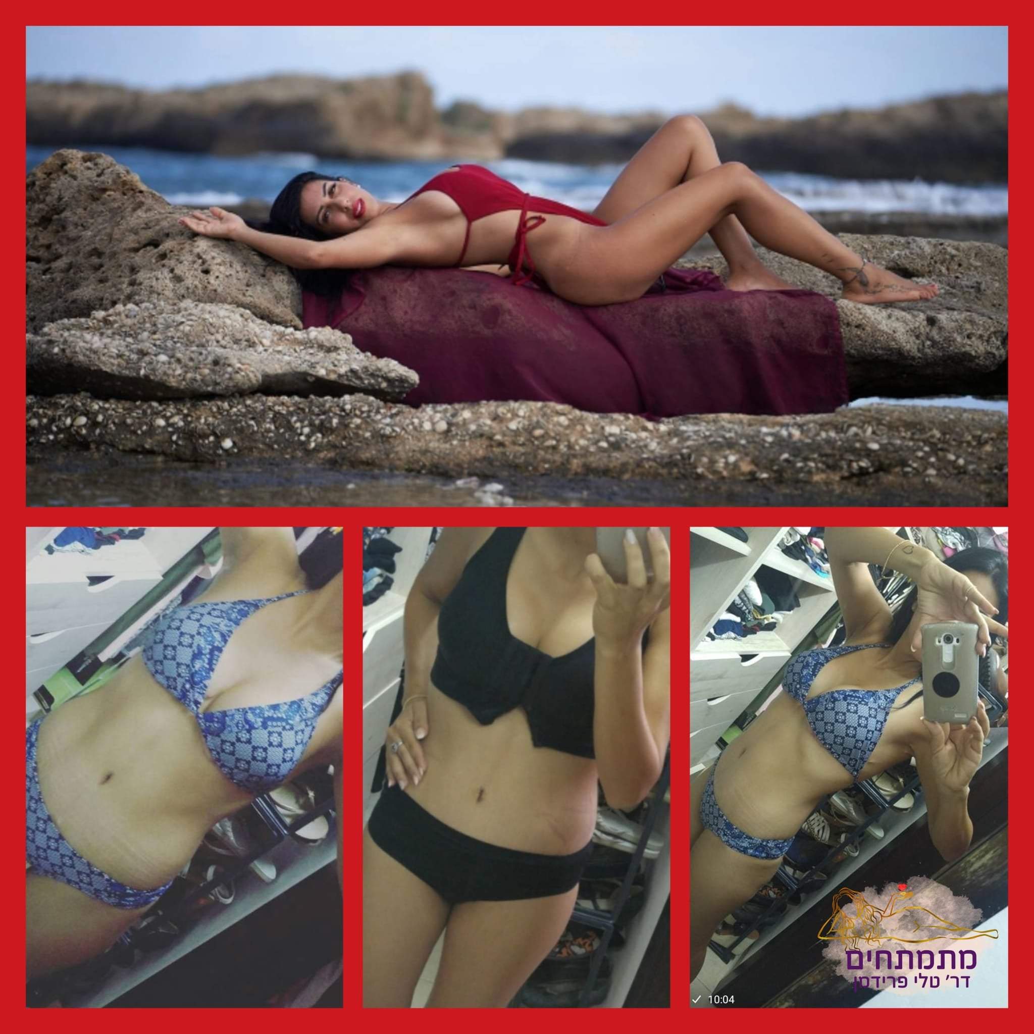 Abdominoplastie - Lifting Du Ventre | Dre Tali Friedman