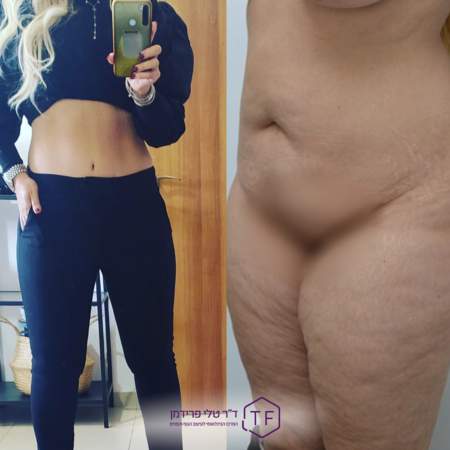 Abdominoplastie - Lifting Du Ventre | Dre Tali Friedman