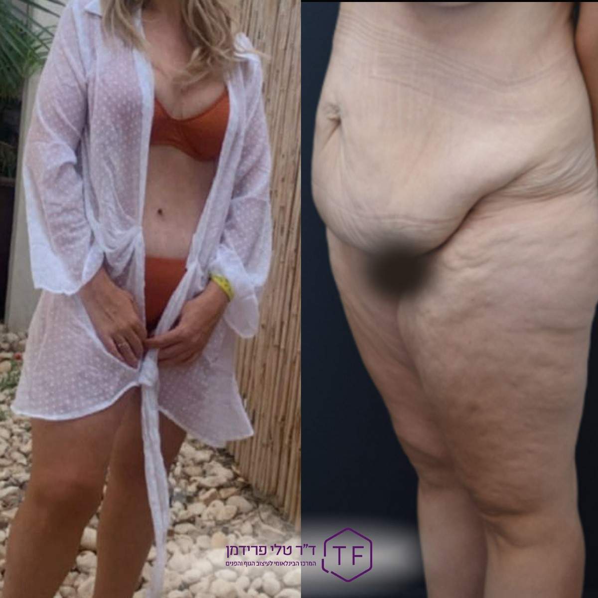 Tummytuck | Dr. Tali Friedman