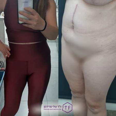 Abdominoplastie - Lifting Du Ventre | Dre Tali Friedman