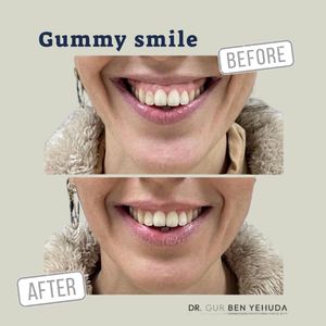 gummy smile