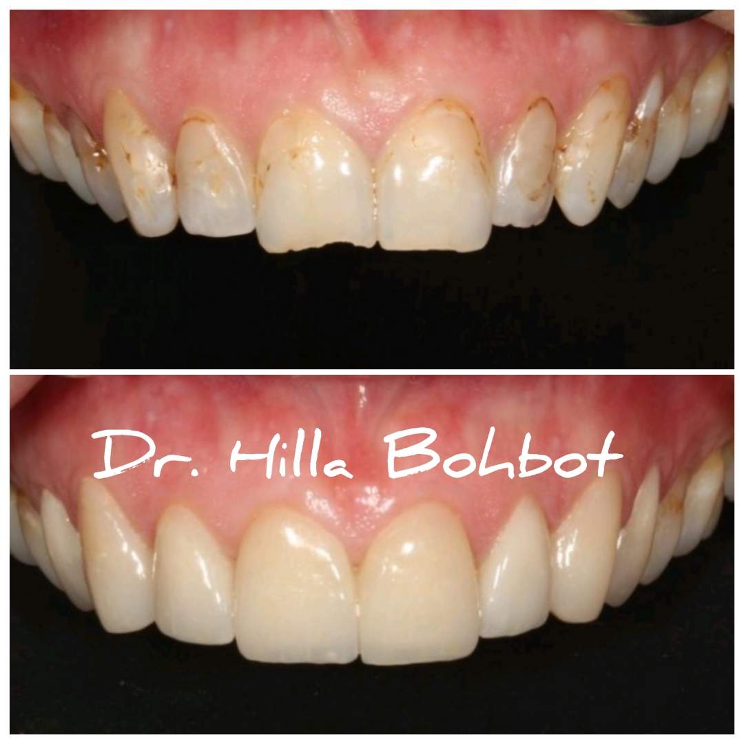 Revêtements Esthétiques (Stratifié, Zircone, Porcelaine, Composite) | Dr. Hilla Bohbot
