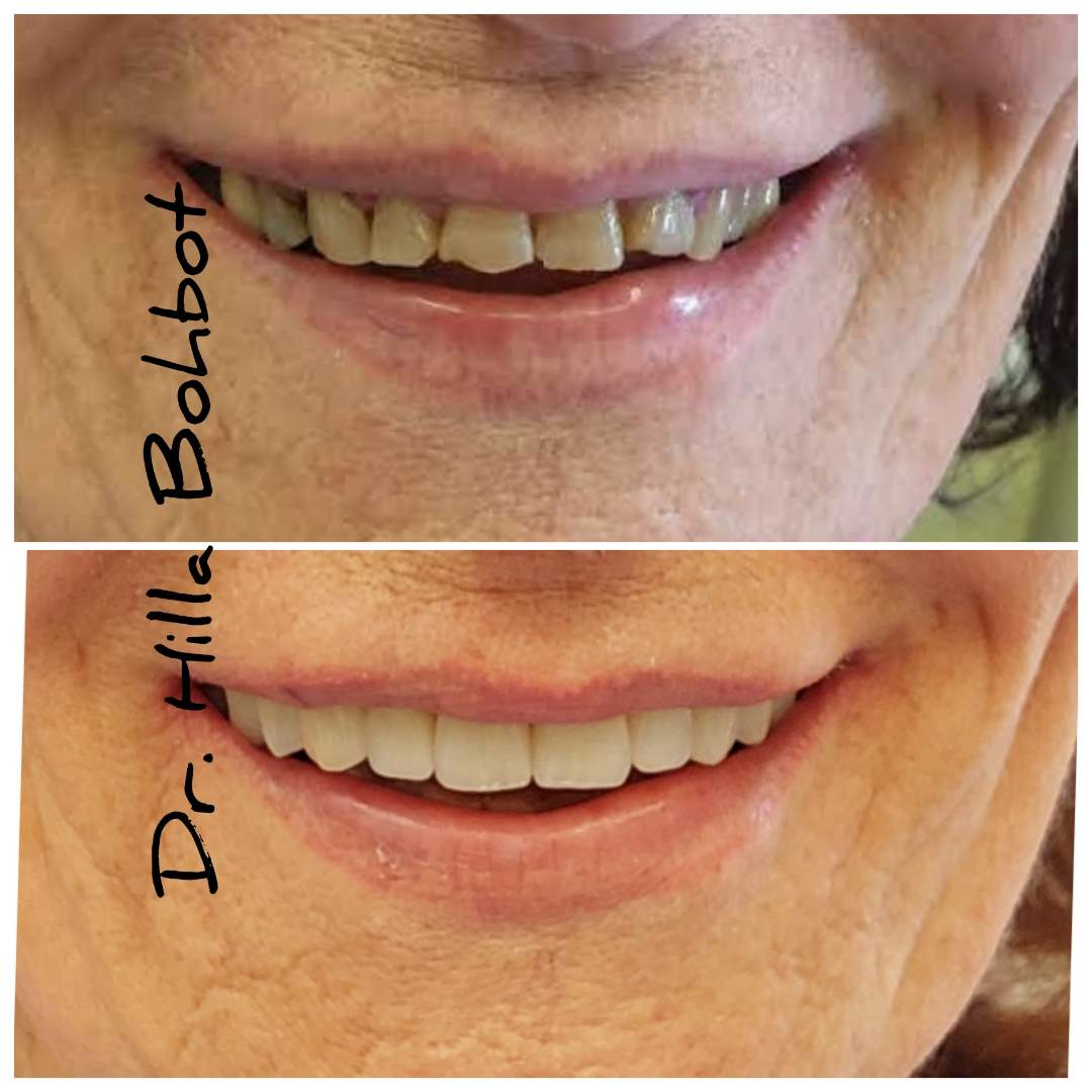 Prosthodontie | Dr. Hilla Bohbot