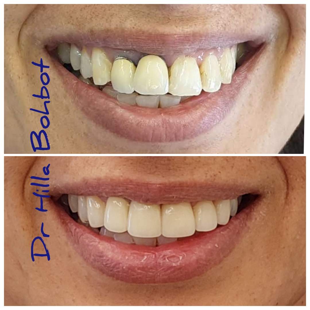 Revêtements Esthétiques (Stratifié, Zircone, Porcelaine, Composite) | Dr. Hilla Bohbot