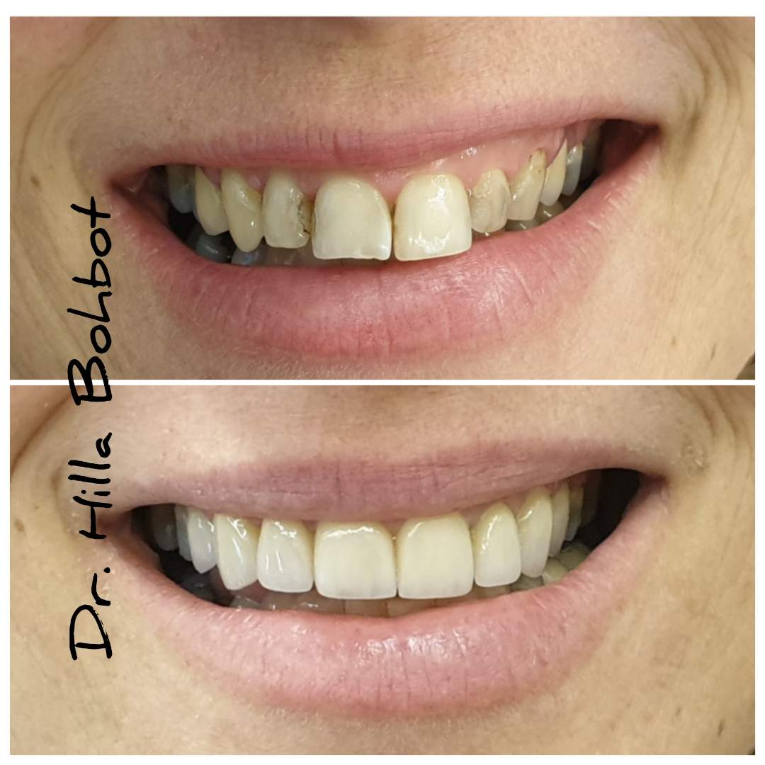 Tooth Colored Restoration | Dr. Hilla Bohbot