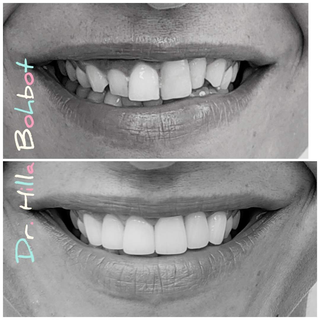 Réhabilitation Complexe De La Bouche | Dr. Hilla Bohbot