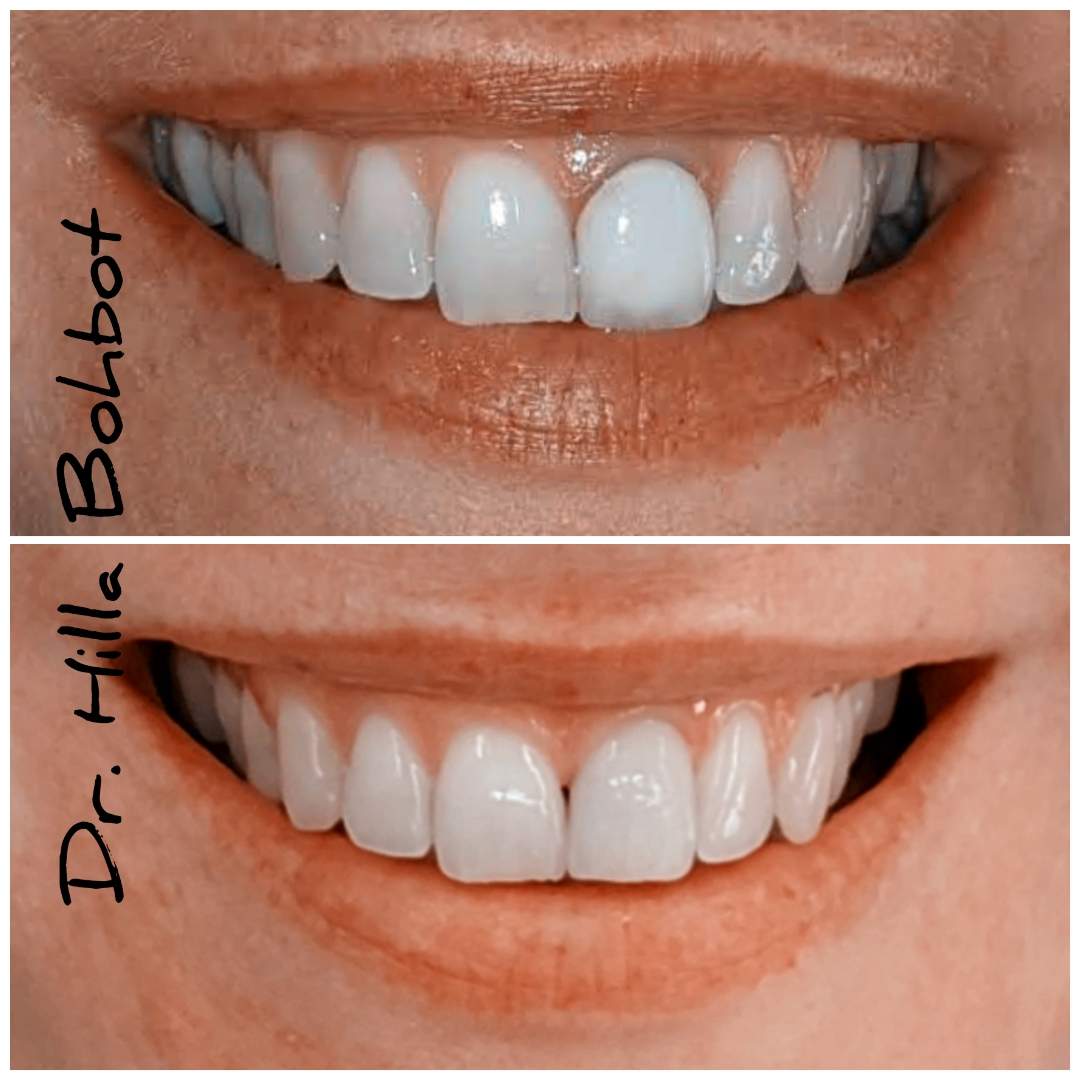 Allongement De La Couronne | Dr. Hilla Bohbot