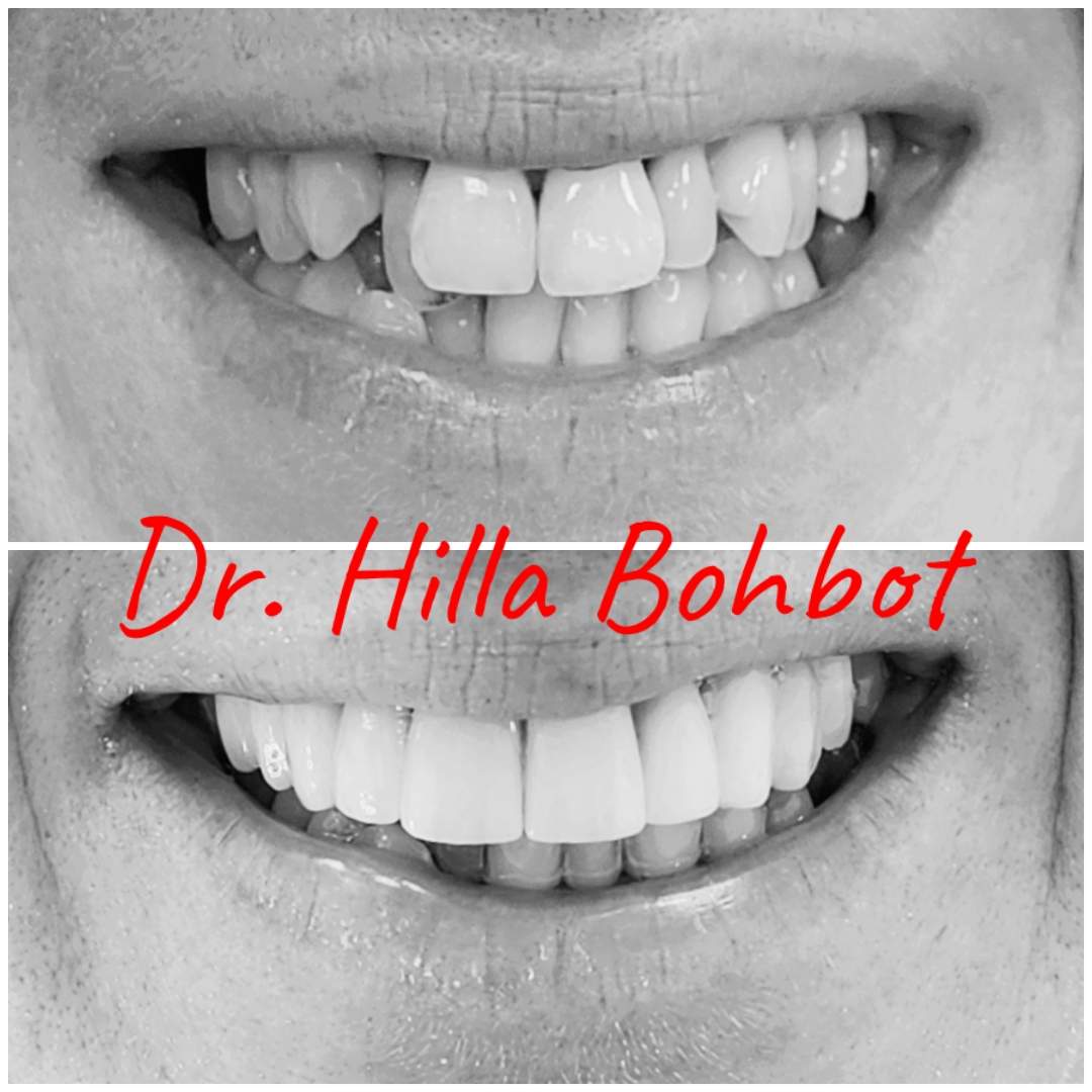 Prosthodontie | Dr. Hilla Bohbot
