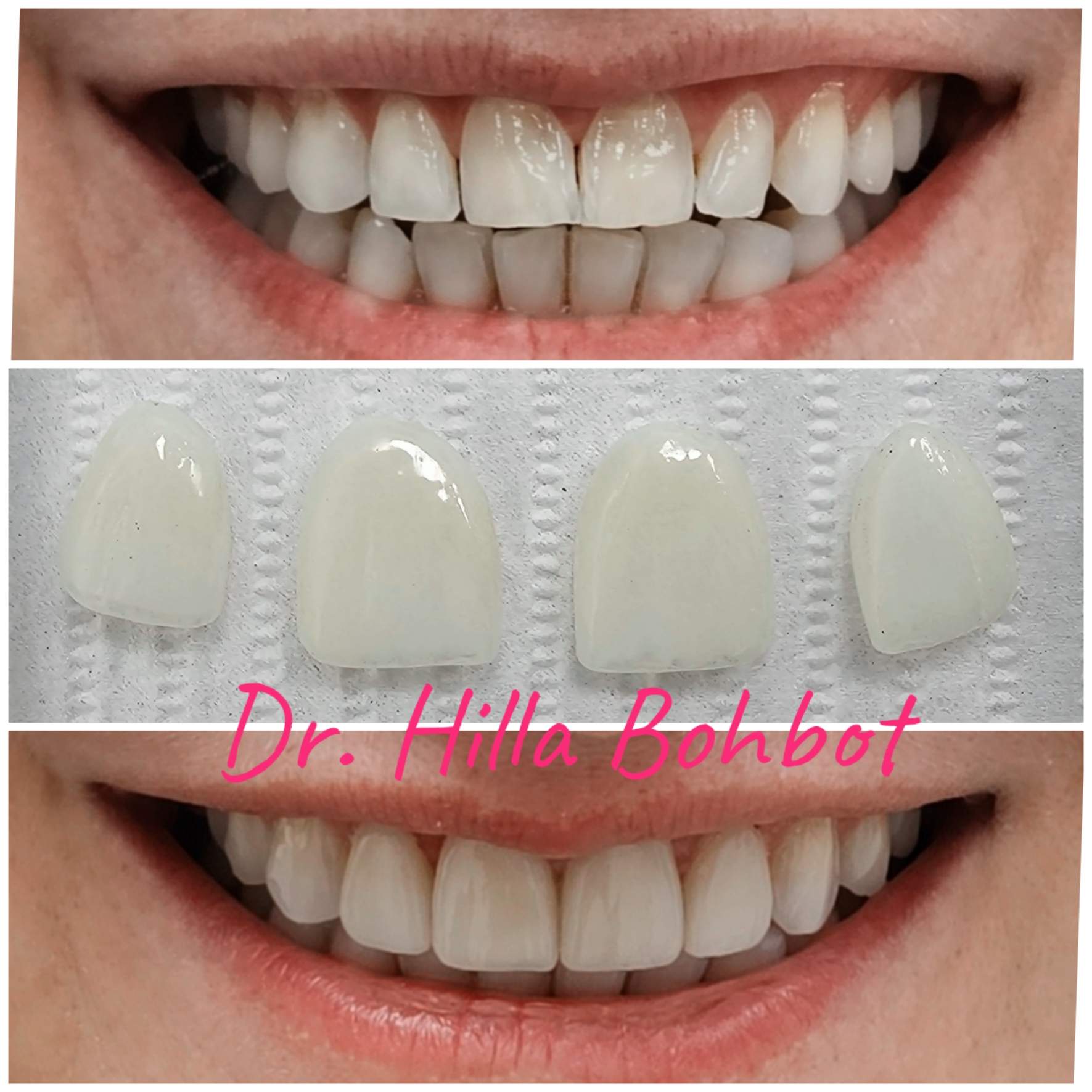 Soins Esthétiques Dentaires | Dr. Hilla Bohbot