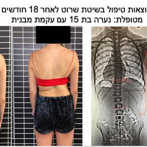פיזיותרפיה | ד"ר חגית ברדיצ'בסקי