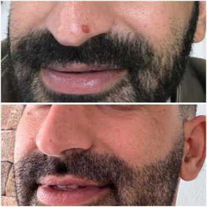 הסרת שומות בלייזר