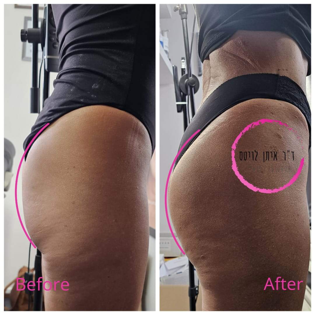 طب التجميل | د. إيتان لفيتس