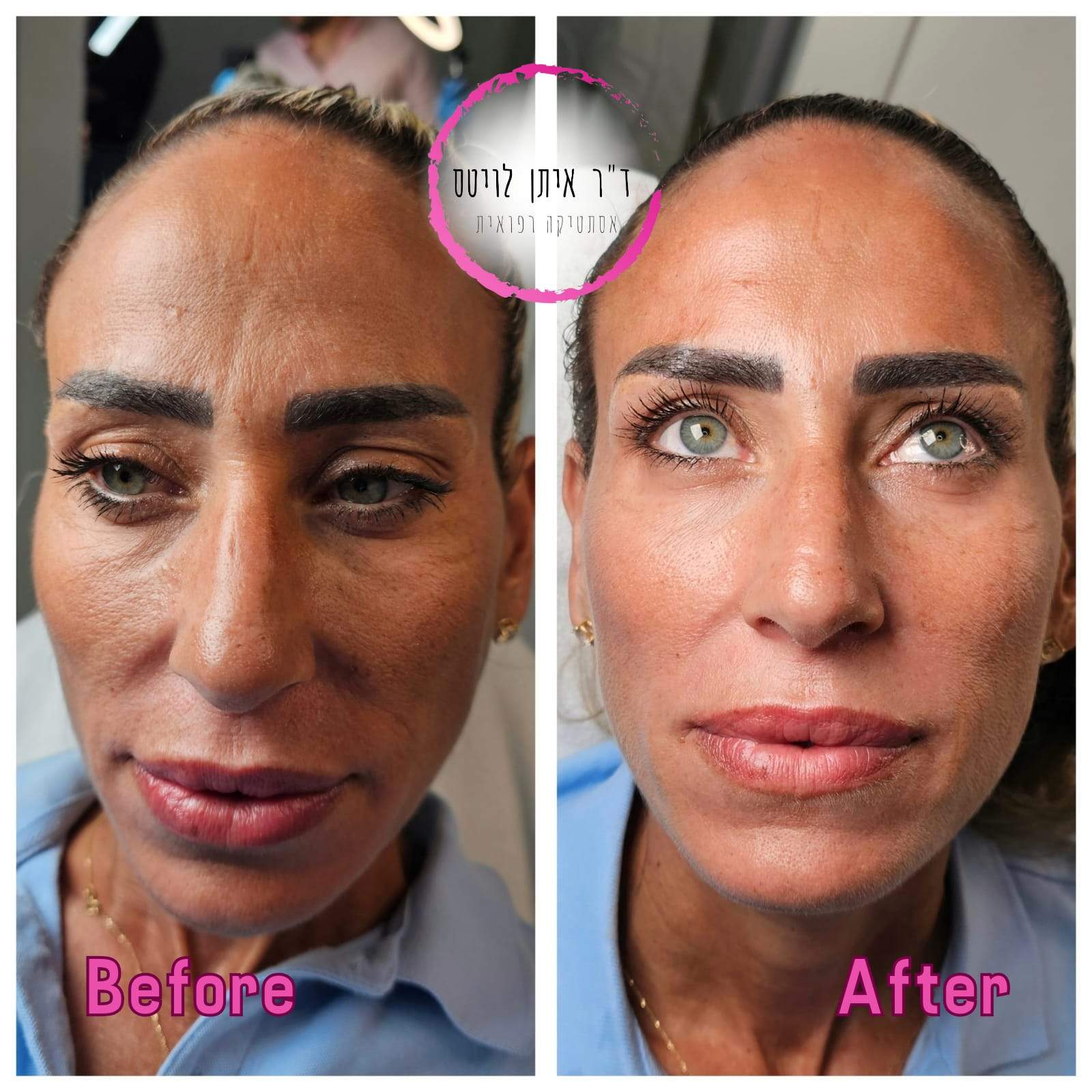 طب التجميل | د. إيتان لفيتس