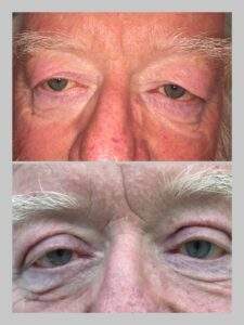 Plastic Eyes And Chimney | Dr. Aleza Andron