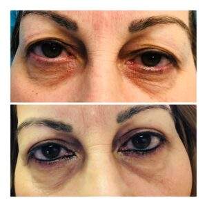 Plastic Eyes And Chimney | Dr. Aleza Andron