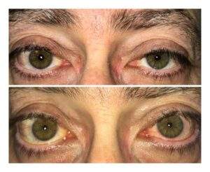Plastic Eyes And Chimney | Dr. Aleza Andron