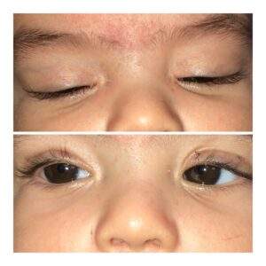 Plastic Eyes And Chimney | Dr. Aleza Andron