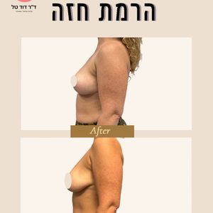הרמת חזה