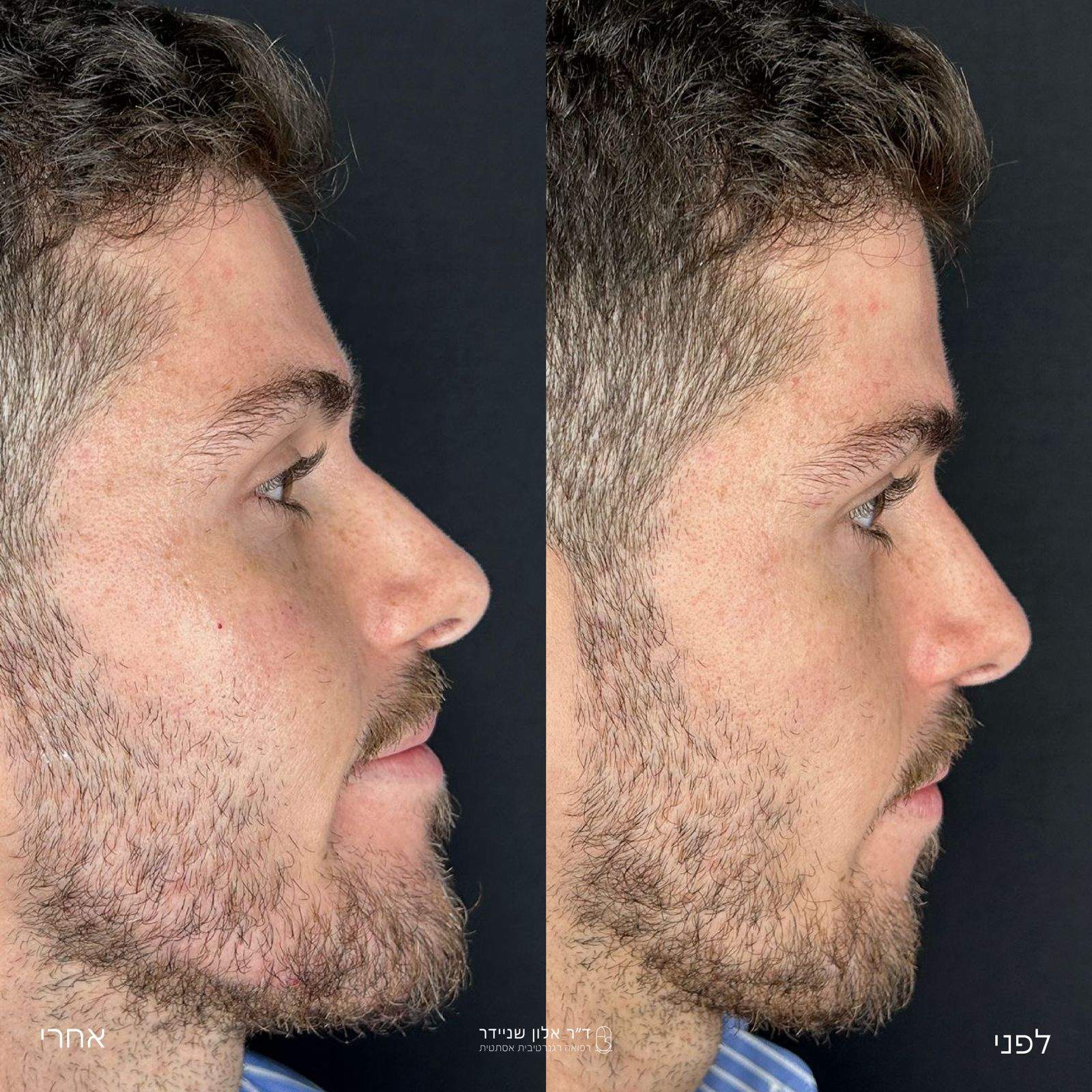 طب التجميل | الدكتور ألون شنايدر عيادة نورديكا