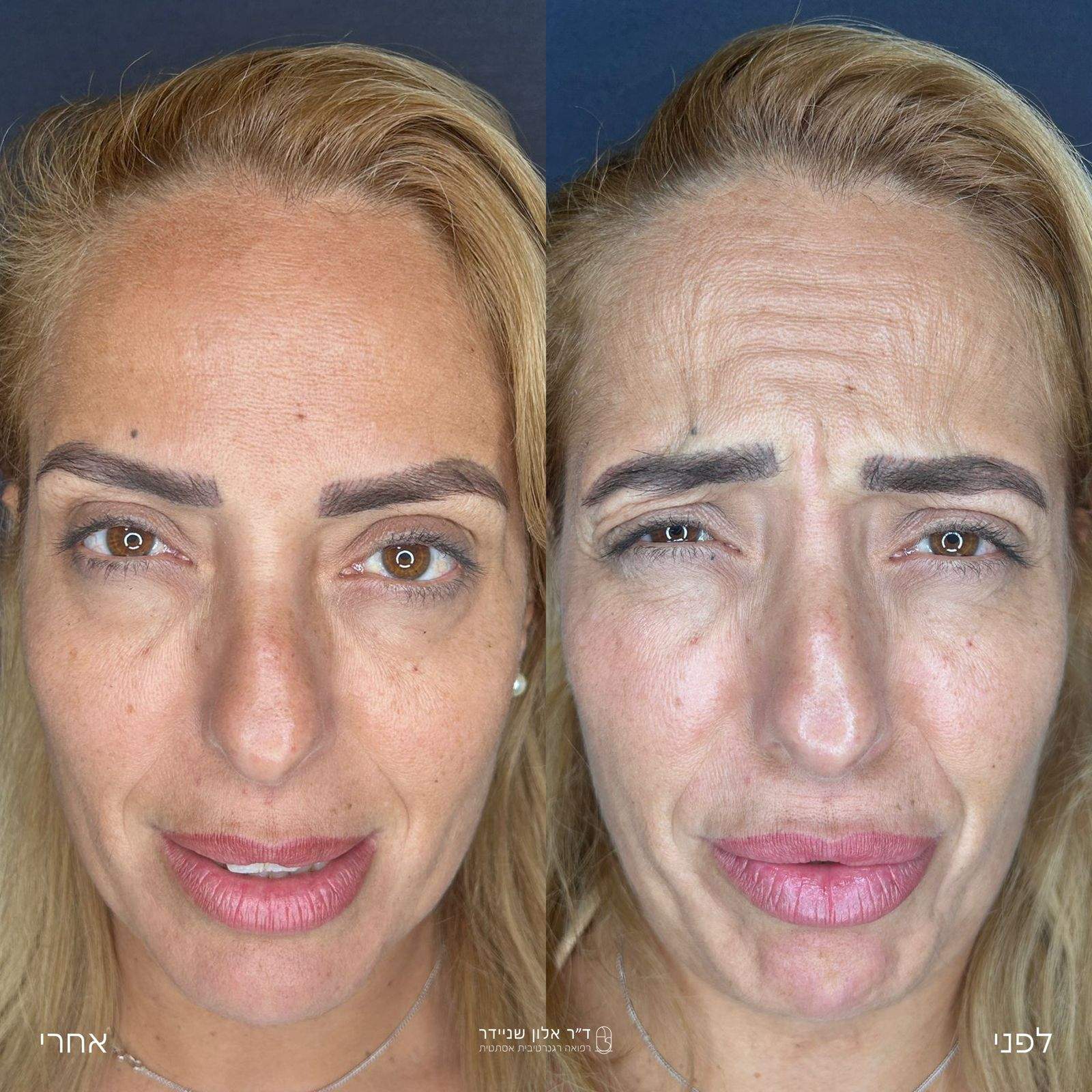 طب التجميل | الدكتور ألون شنايدر عيادة نورديكا