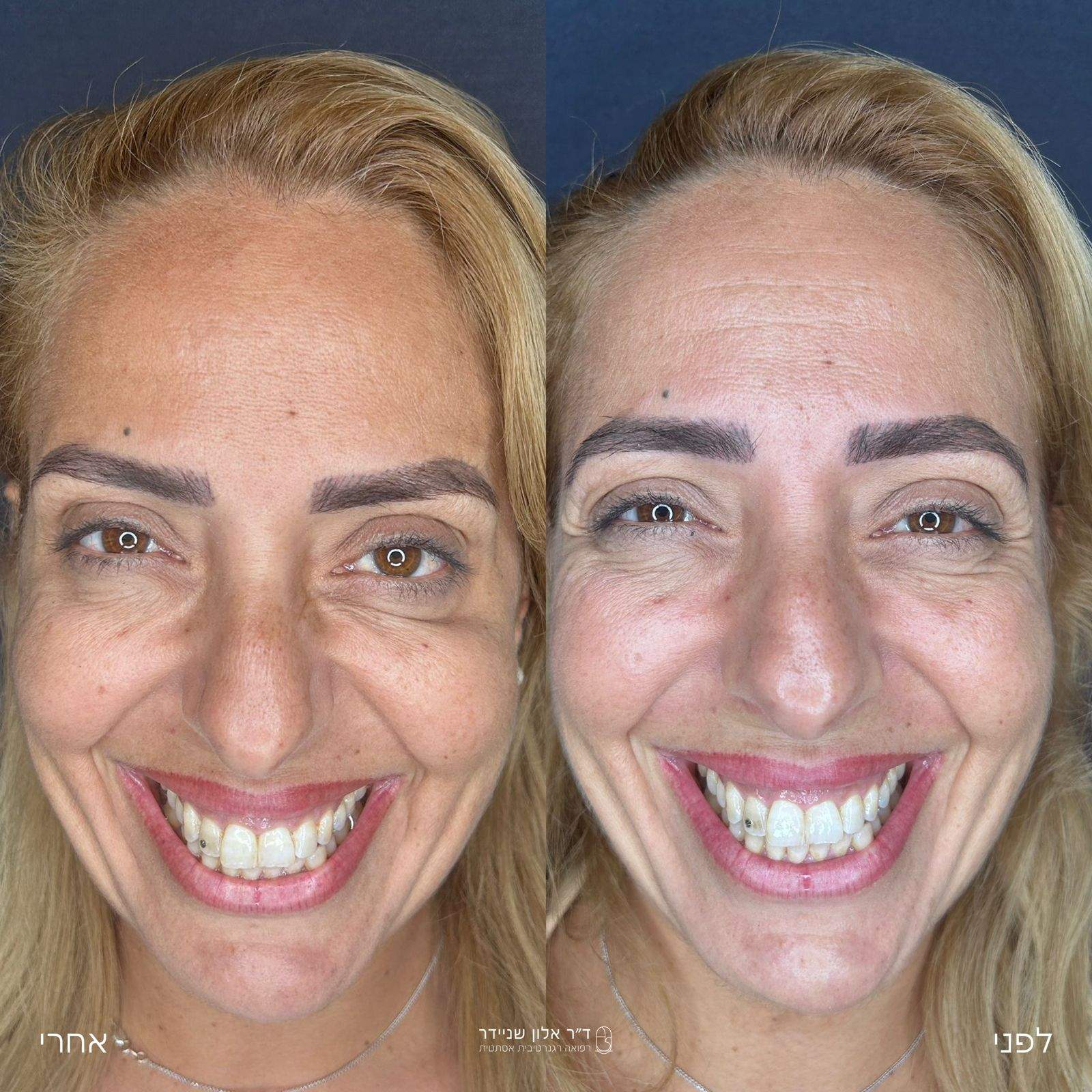طب التجميل | الدكتور ألون شنايدر عيادة نورديكا