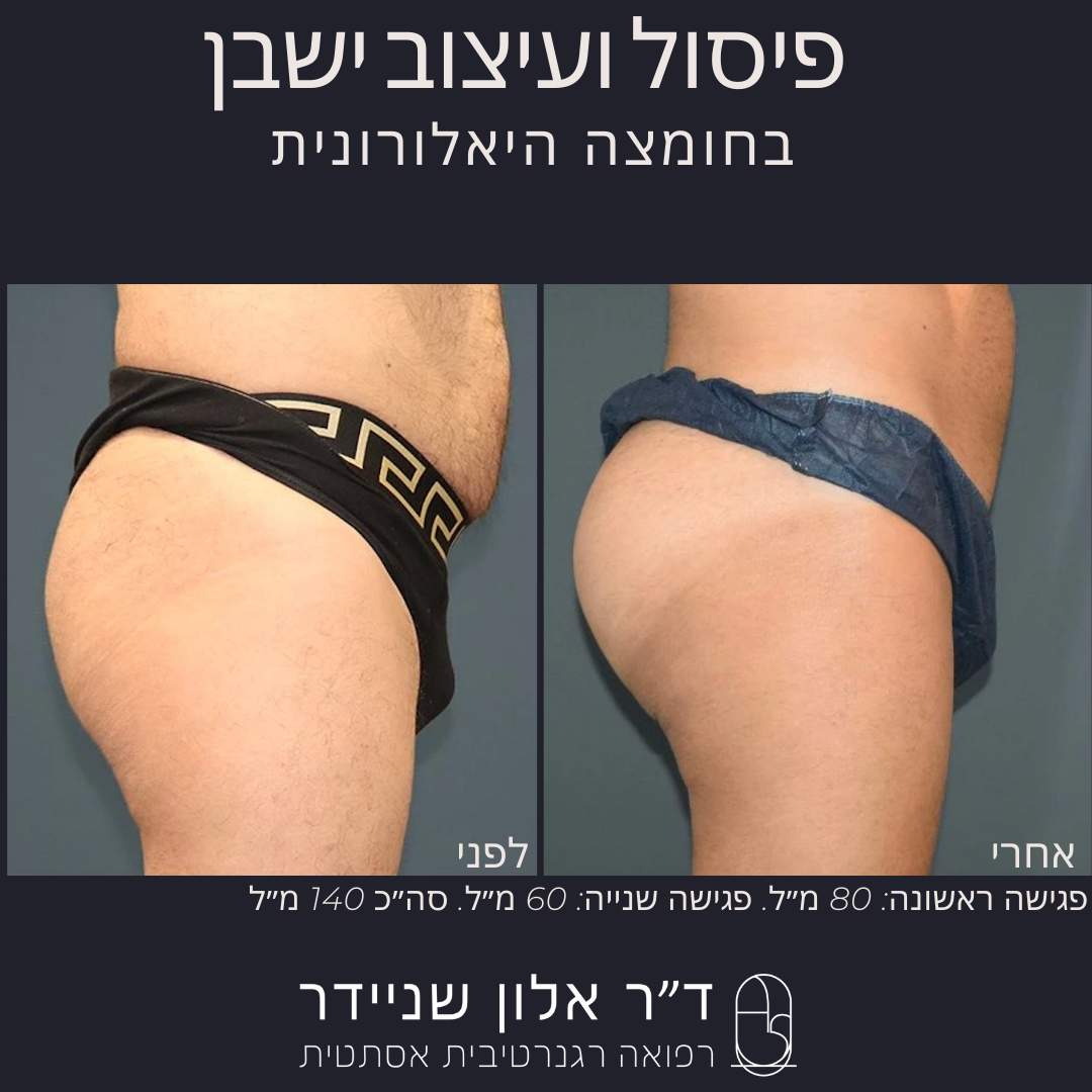 طب التجميل | الدكتور ألون شنايدر عيادة نورديكا